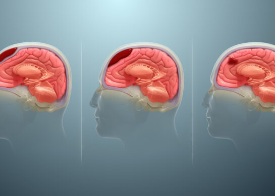 Гематома в головном мозге
